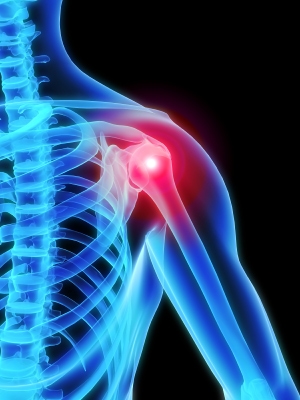 Stem Cell Numbers and Shoulder Partial Rotator Cuff Tear / Tendinosis