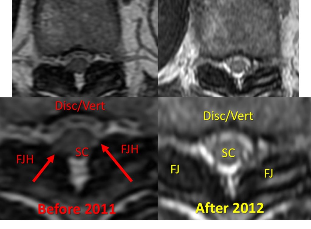 upper back surgery procedures
