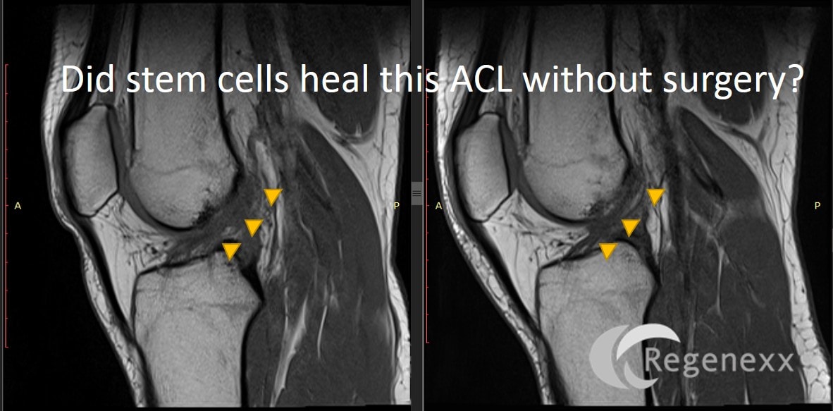 acl surgery cost acl surgery cost acl surgery cost acl surgery cost
