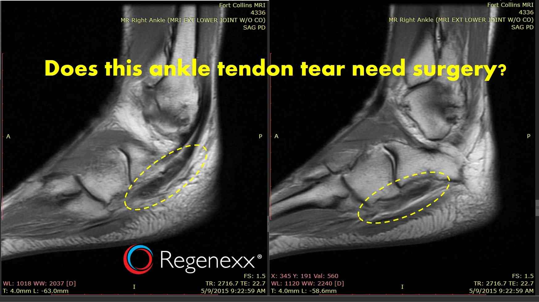 how to to heel how to heal a torn tendon naturally the type of tear matters regenexx 174 how to to heel how to heal a torn tendon naturally the type of tear matters regenexx 174