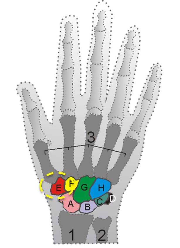 Remove Trapezium Bone.png thumb surgery remove trapezium bone