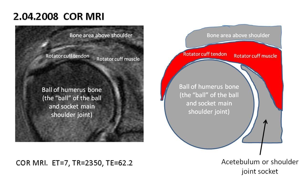 rotator cuff tear mri
