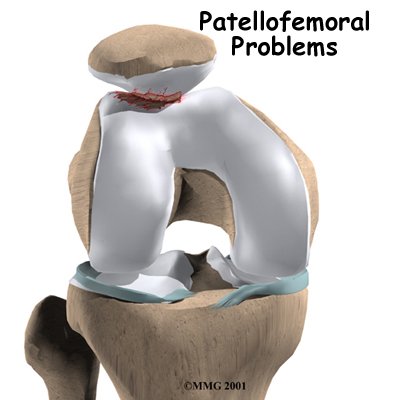 Patellofemoral Arthritis (Knee Cap) or Syndrome