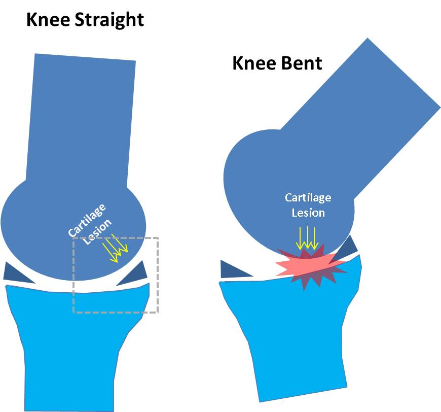 Stem Cell Knee Cartilage