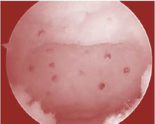 knee pain after microfracture surgery knee pain after micro fracture surgery