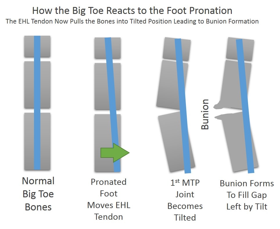 What are the causes of bunions?