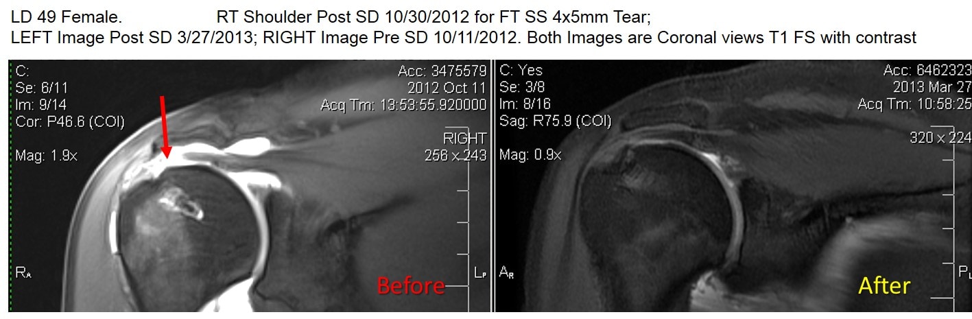 rotator cuff tear mri