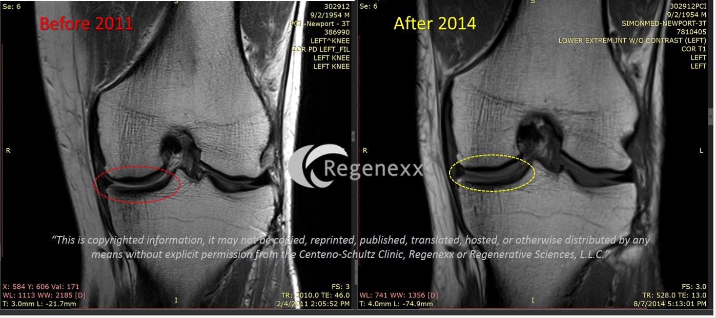 juvenile rheumatoid arthritis