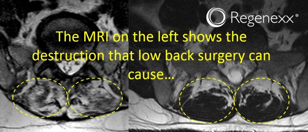 Mutifidis Problems Creedt by Surgery