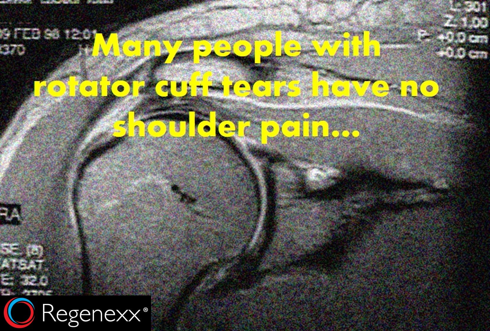 rotator cuff tear mri